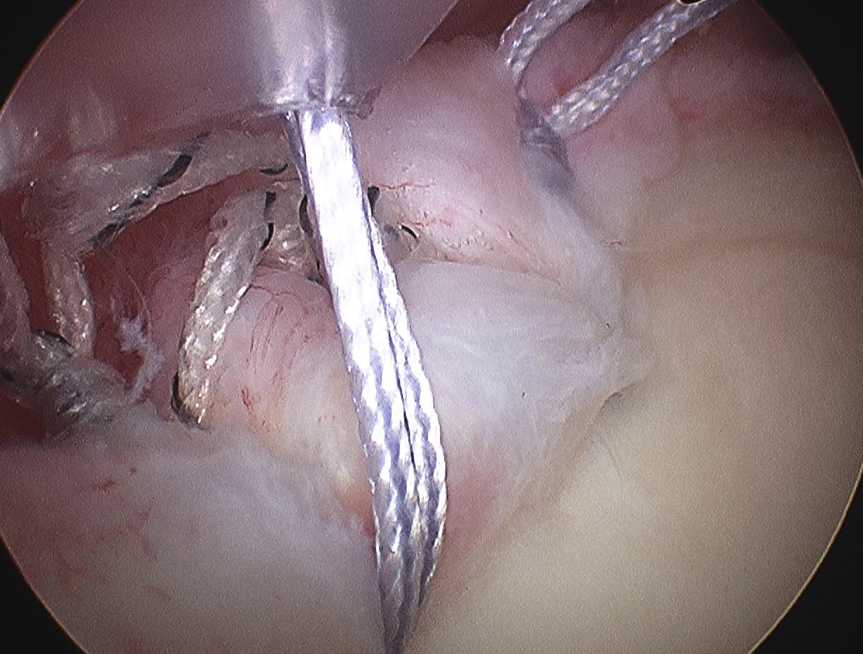 Posteior Labral Repair